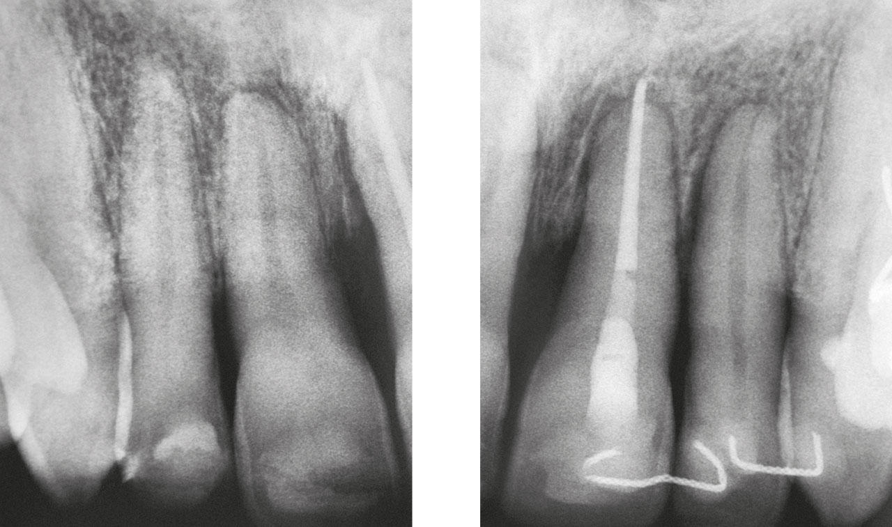 Abb. 10 Deutliche Verbesserung der parodontalen Situation mit offensichtlicher Wurzelresorption an Zahn 21.