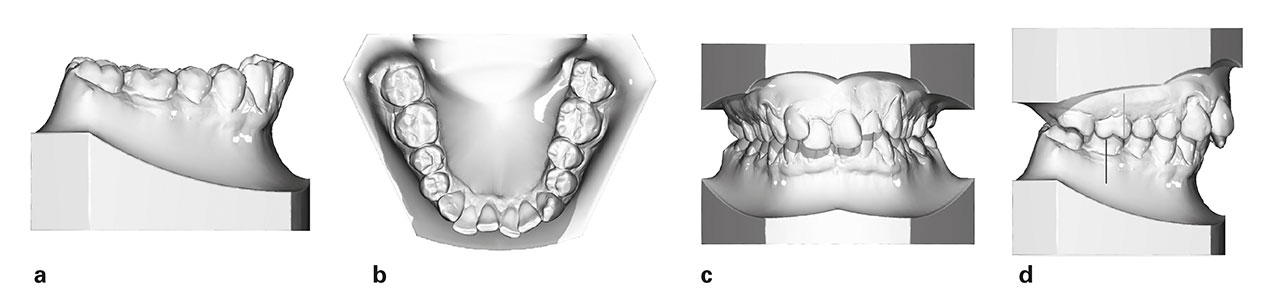 Abb. 3a bis d  Darstellung der dentobasalen Situation vor Behandlungsbeginn mit einer „Mandibular advancement device“ (MAD) bei einem ausgewachsenen Patienten.