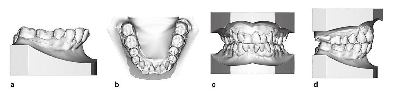 Abb. 4a bis d  Darstellung der dentobasalen Situation nach Behandlung mit einer MAD ohne körperliche Fassung aller Zähne (Doppelvorschubplatte). Es zeigt sich eine deutliche Protrusion der unteren Frontzähne sowie eine Mesialkippung der Zähne im Seitenzahnbereich als Ausdruck einer Nebenwirkung der Kraftauswirkung der MAD.