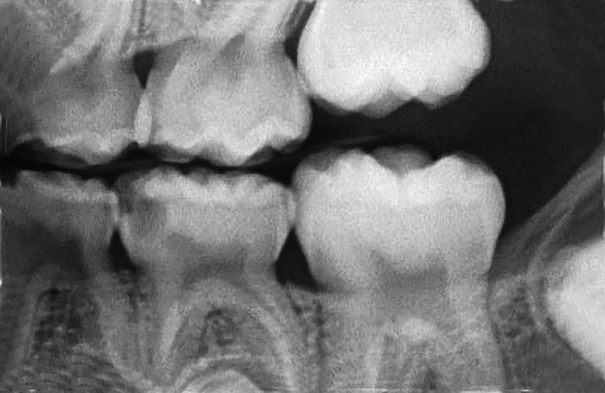 Abb. 5a Zahn 75 zeigt eine Caries profunda (a), welche mit einem Erbium:YAG-Laser exkaviert wurde. Zudem erfolgte die Kavitäten­präparation vor der adhäsiven Restauration laserbasiert.
