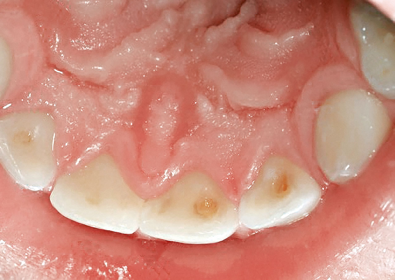 Abb. 6a Beginnende Dentinläsionen an den Palatinalflächen oberer Milchfrontzähne vor ...