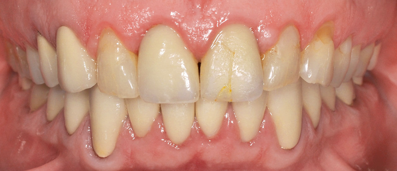 Abb. 6a Initiale Situation mit funktionell abradierten Zähnen, provisorisch repariertem Chipping an der Krone 21 und überkonturierten Kronenrändern.