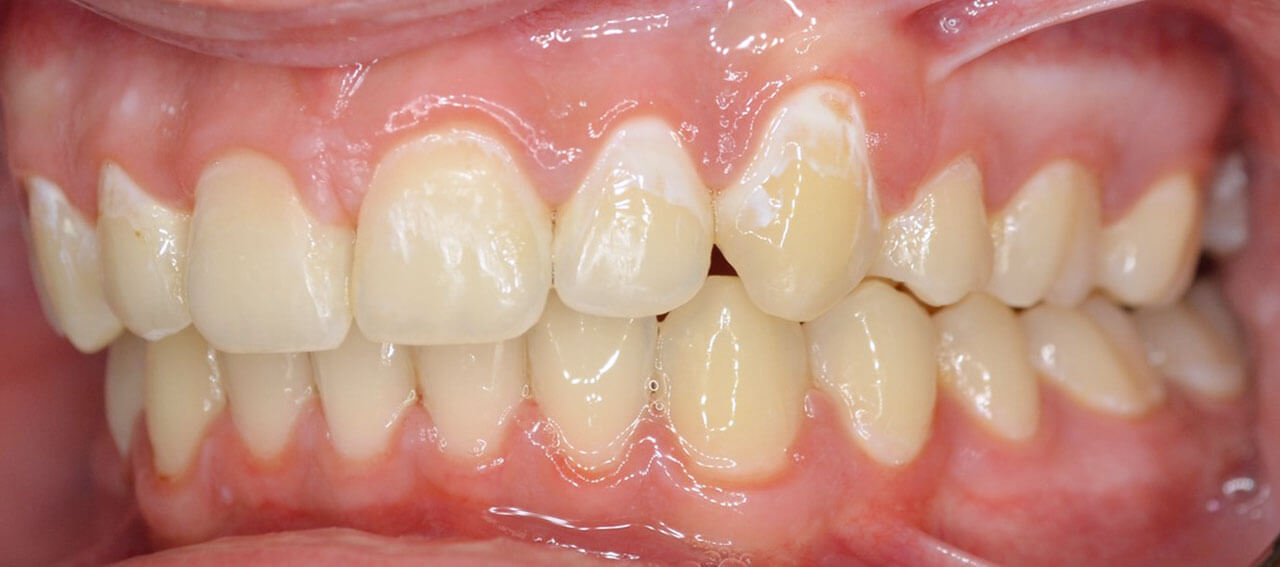 Abb. 1: „White spots“ im Bereich der Zahnhartsubstanz nach Entfernung der Multibracketapparatur bei einem 16-jährigen Patienten