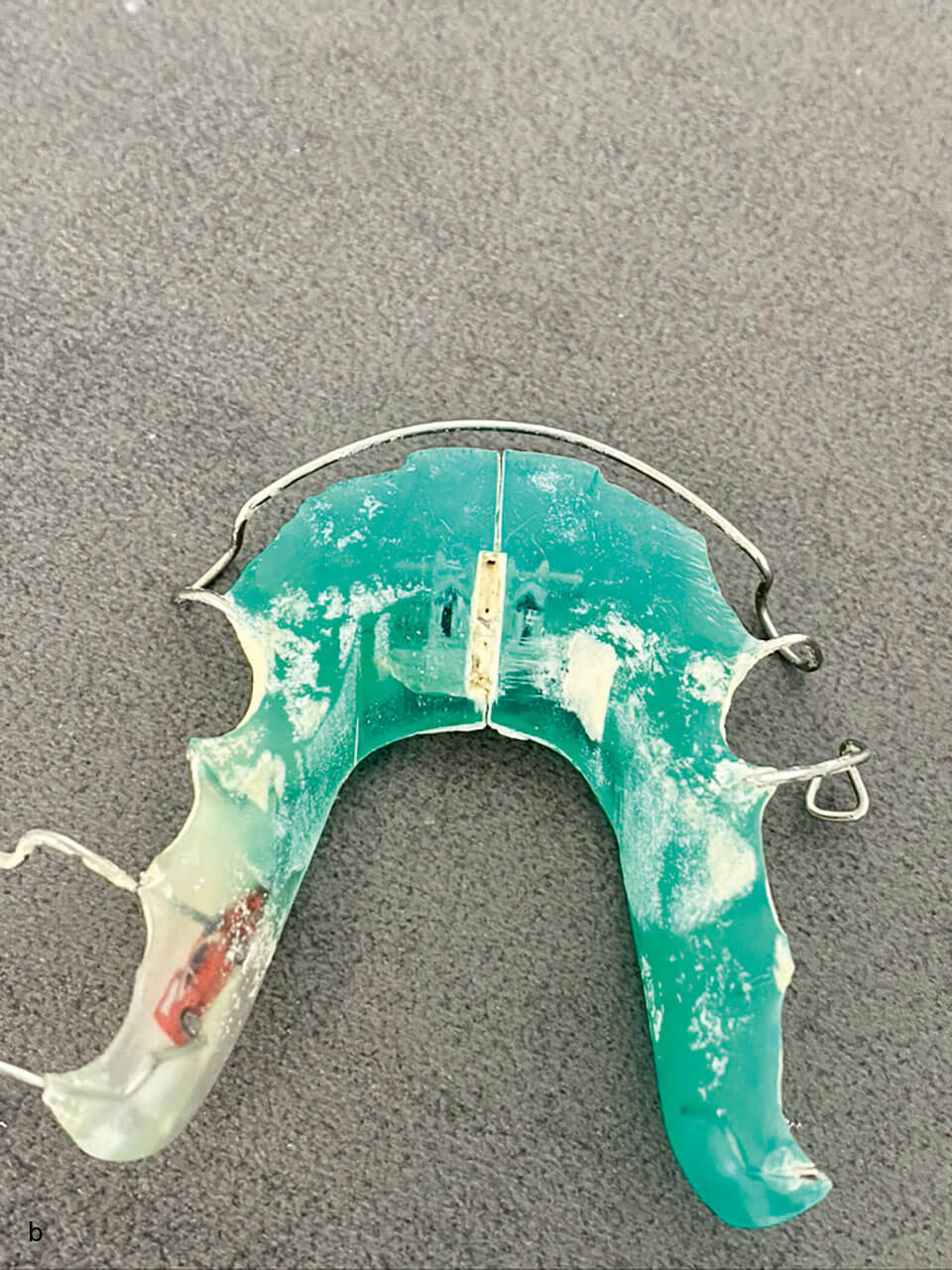 Abb. 3b: Stark verschmutze Apparatur – Gerade an unter sich gehenden Bereichen ist eine optimale Reinigung seitens des Patienten schwer möglich. Die Stellschraube ist so sehr mit Zahnstein verschmutzt, dass ein Stellen nicht mehr möglich ist.