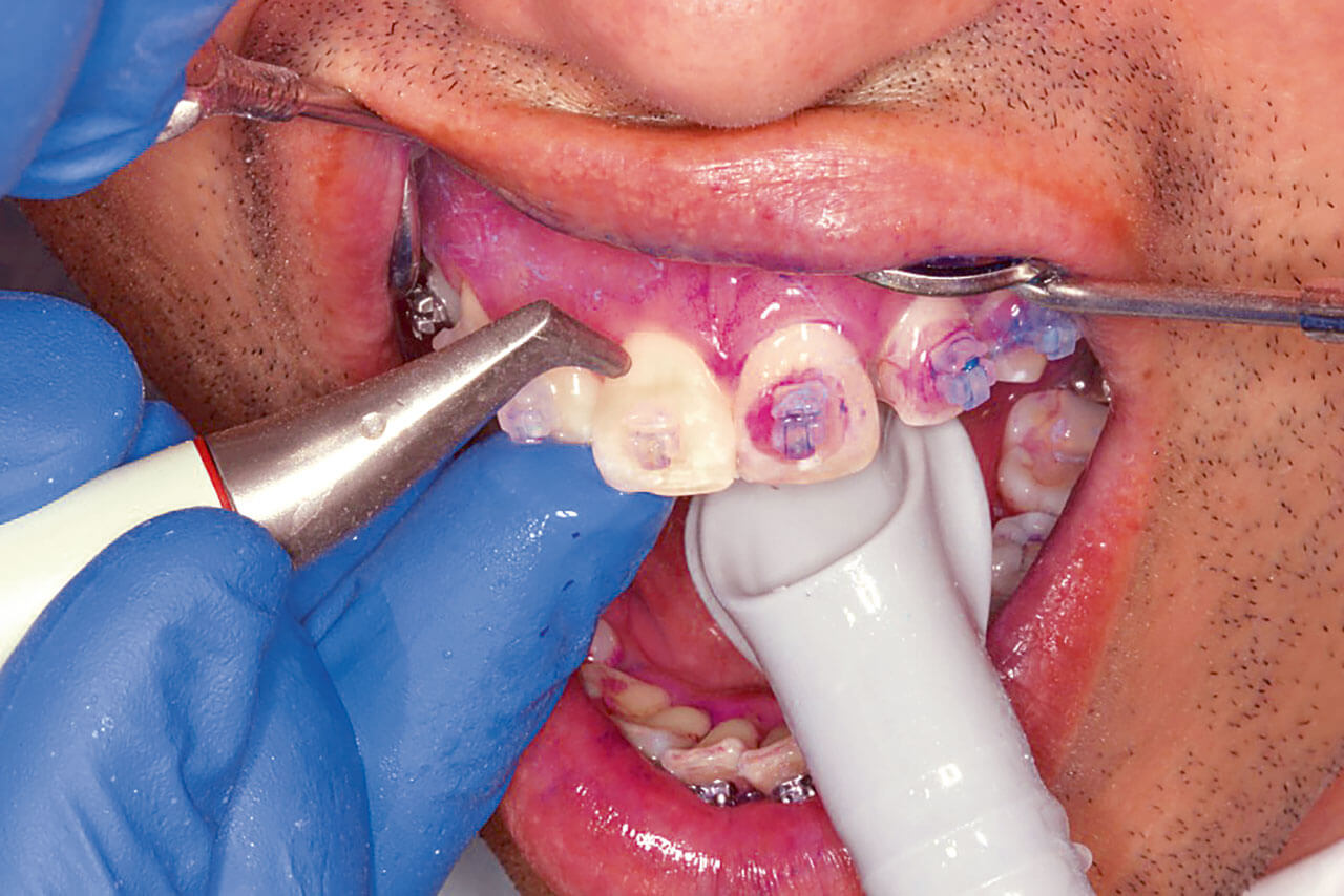 Abb. 18: Politur der Glattflächen mittels Airflow unter Verwendung des Airflow Plus Pulvers bei einem kieferorthopädischen Patienten als Bestandteil der professionellen Zahnreinigung