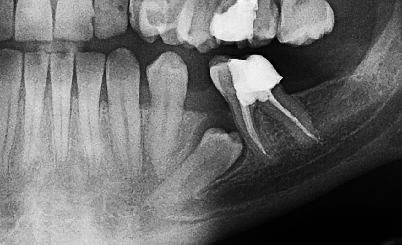 Abb. 1 Normalerweise erfolgen die Wanderung der Zahnkeime und der Zahndurchbruch von distal nach mesial. Wenn er einmal umgekehrt von mesial nach distal erfolgt, ist die Gefahr der Durchbruchsstörung größer, weil der Zahn am distalen Nachbarn hängen bleiben kann, wie hier an Zahn 35 zu sehen ist.