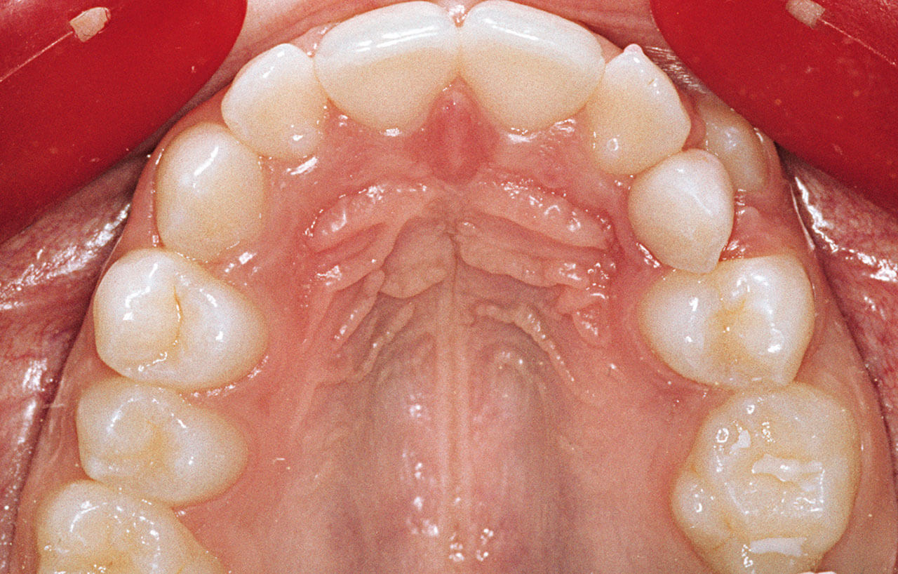 Abb. 2 Zahn 25 hat keine Chance zum korrekten Durchbruch, weil die Zähne 24 und 26 den Platz vollständig in Anspruch nehmen – insbesondere durch die Drehung des Sechsjahrmolaren 26 um 45°.

