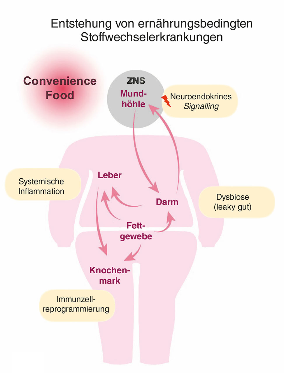 Abb. 1c Die durch die westliche Ernährungsweise bedingte Dysbiose im Orodigestivtrakt führt zu einer gestörten Barriereintegrität. Dadurch wandern verstärkt schädliche Mikroben und mikrobielle Metabolite in den Blutkreislauf ein und rufen systemische Entzündungsreaktionen hervor. Diese beeinflussen den Energiestoffwechsel verschiedener Organe, unter anderem im Fettgewebe, in der Leber, im Knochenmark und im zentralen Nervensystem (ZNS). Langfristig führen ein gestörter Energiestoffwechsel und ein erhöhter inflammatorischer Tonus in den einzelnen Geweben und Organen, aber auch systemisch, zur Entwicklung von metabolischen Lifestyle-Erkrankungen wie Adipositas, Diabetes mellitus Typ 2, kardiovaskulären Erkrankungen, neurodegenerativen Erkrankungen sowie Erkrankungen in der Mundhöhle. 