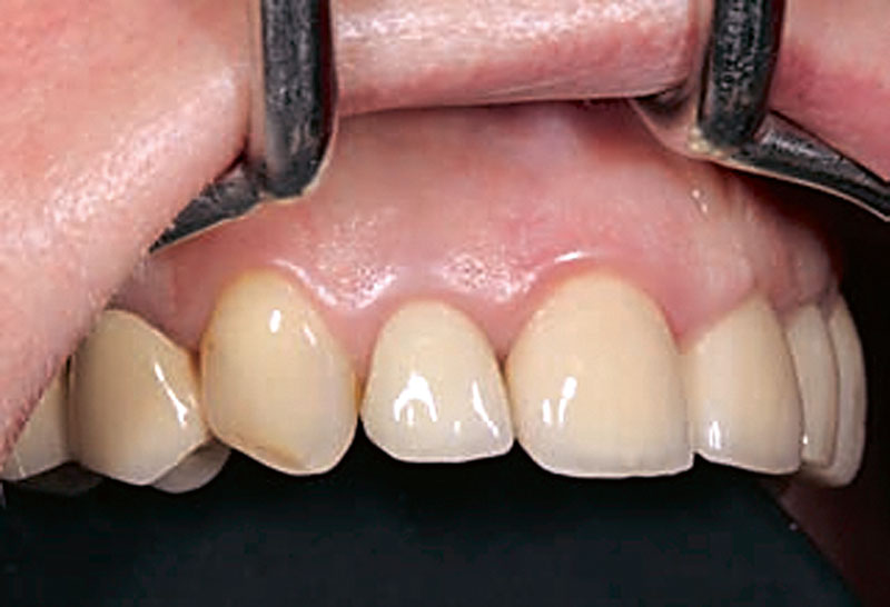 Abb. 1 Klinische Ausgangsituation des Zahns 12.