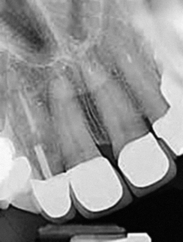 Abb. 2 OPG des Zahns 12: Endodontischer Misserfolg mit dislozierter Stiftversorgung und tiefer komplizierter Fraktur.