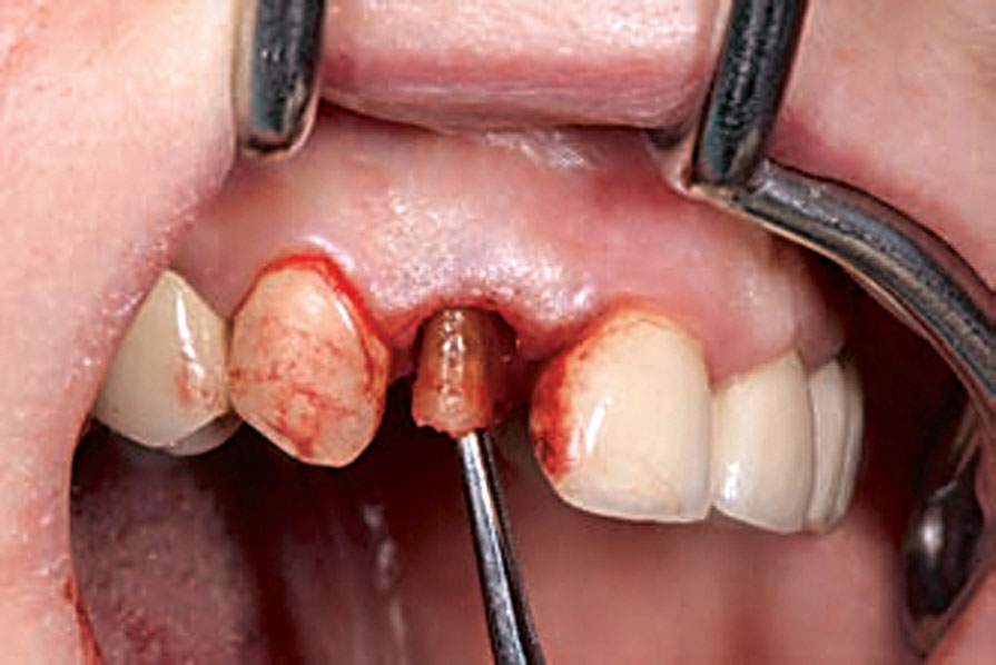 Abb. 4 Atraumatische Extraktion des Zahns bzw. des frakturierten Fragments.