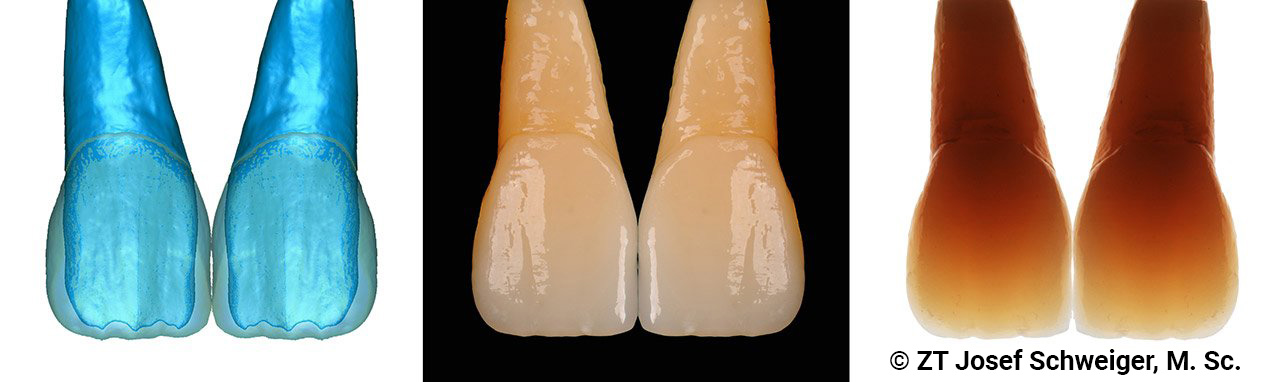 Weltneuheit: Mittels Lithoz LCM-3D-Druckverfahren mehrschichtig gedruckte Zähne aus Lithium-Disilikat auf der Basis von Daten aus der „Schweiger Zahnstrukturdatenbank“.