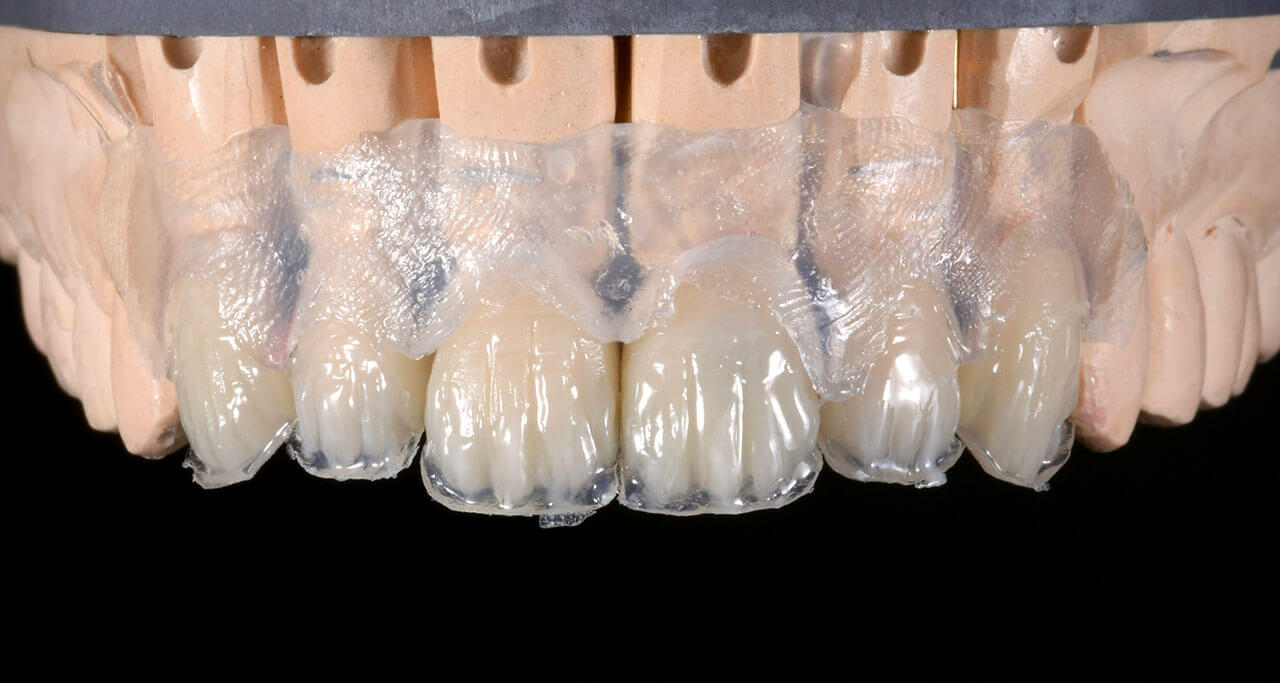 Abb. 24 Um die interne Struktur mit Kompositen schichten zu können, waren die PMMA-Kronen im Sinne von Dentinkernen reduziert worden.