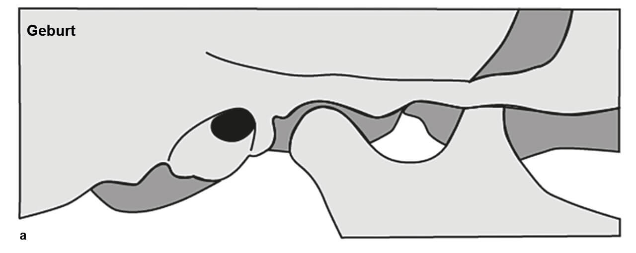 Abb. 5 Anpassung des Kiefergelenks an die Bisshebungen.  Abb. 5 a Zur Geburt ist die Fossa mandibulae noch seicht flach und die Eminentia articularis noch flach. 