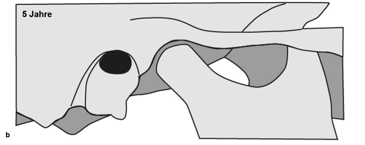 Abb. 5 b Mit etwa fünf Jahren hat die Fossa mandibularis sich etwas vertieft und der Proc. condylaris hat etwas an Länge gewonnen