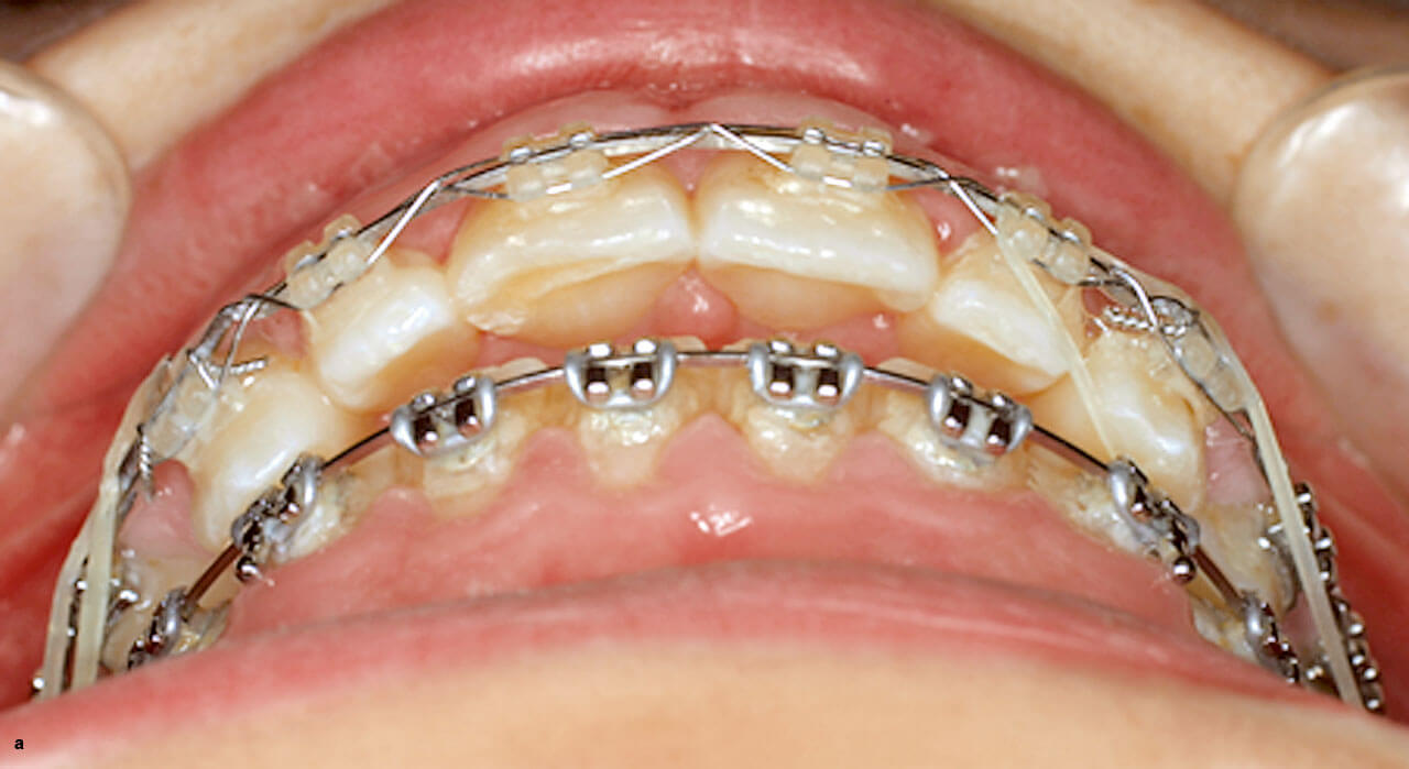 Abb. 10 Durch Eckzähne, die mit ihren palatinalen Flächen zu weit palatinal stehen, kann die Mandibula daran gehindert werden, eine physiologisch korrekte Lage in neutraler Okklusion einzunehmen.  Abb. 10 a Kieferorthopädisch verordnete Klasse-II-Elastics sind dann wirkungslos.