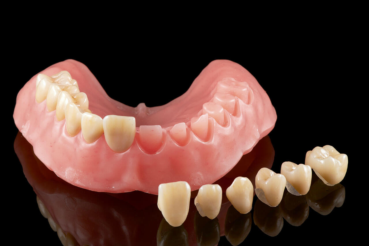 Abb. 12 Individuell hergestellte Zähne, zum Aufkleben bereit.