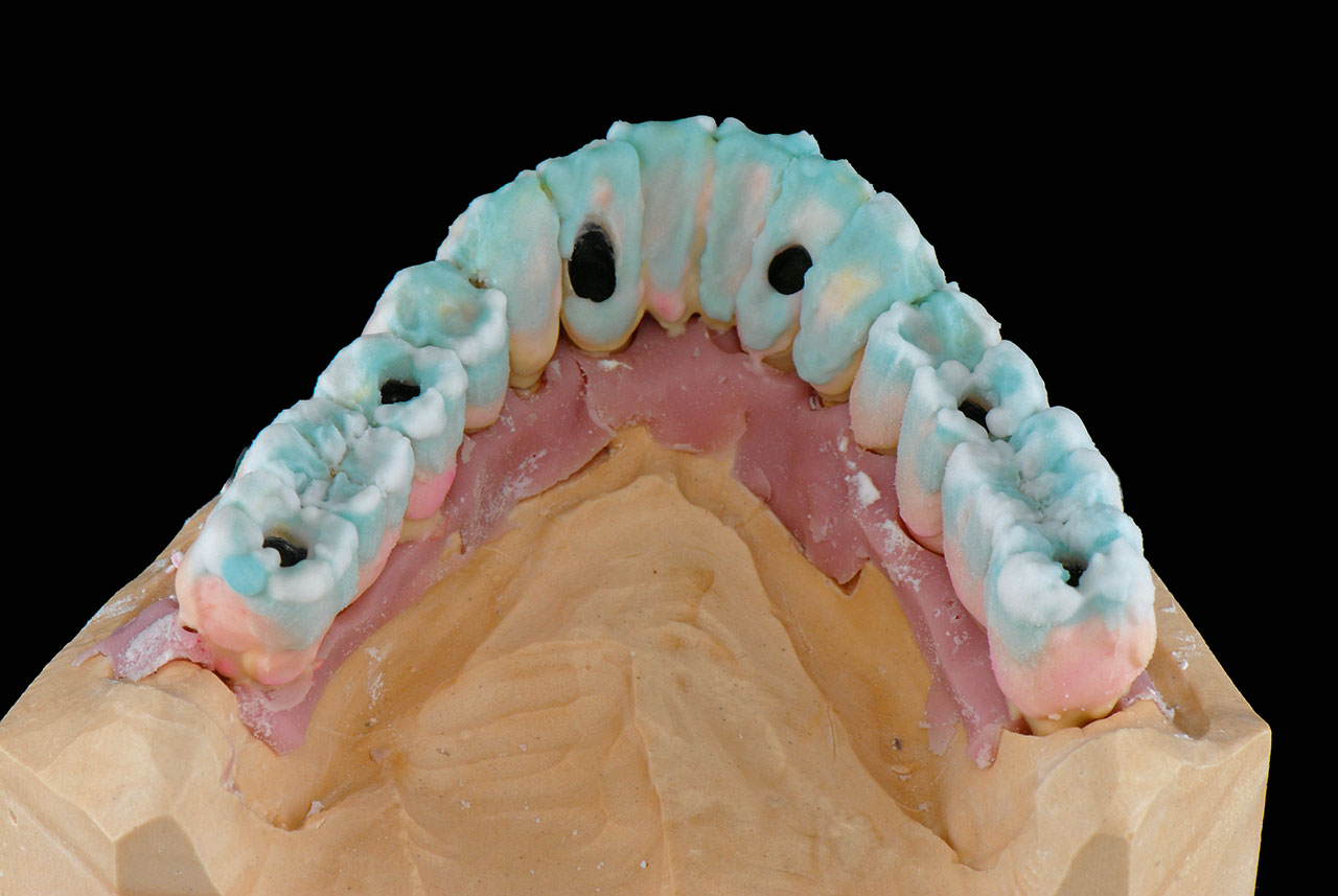Abb. 29 Weil HeraCeram Saphir sehr wenig schrumpft, kann die Morphologie schon für den ersten Dentinbrand detailliert modelliert werden.