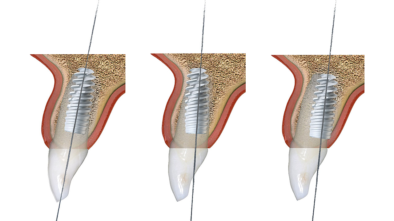 Abb. 3 Verschiedene Möglichkeiten, das Implantat im Frontzahnbereich ohne Achsenkompensation zu positionieren. Position A nimmt auf die Knochenanatomie Rücksicht, führt aber zu einem Achsenverlauf durch die Schneidekante. Position B führt zu einem idealen Achsenverlauf durch das Cingulum, aber auch zu einer sehr engen Lagebeziehung des Implantatapex zur vestibulären Kortikalis. Position C geht mit einer sehr geringen palatinalen Knochendicke im Zahnhalsbereich einher.