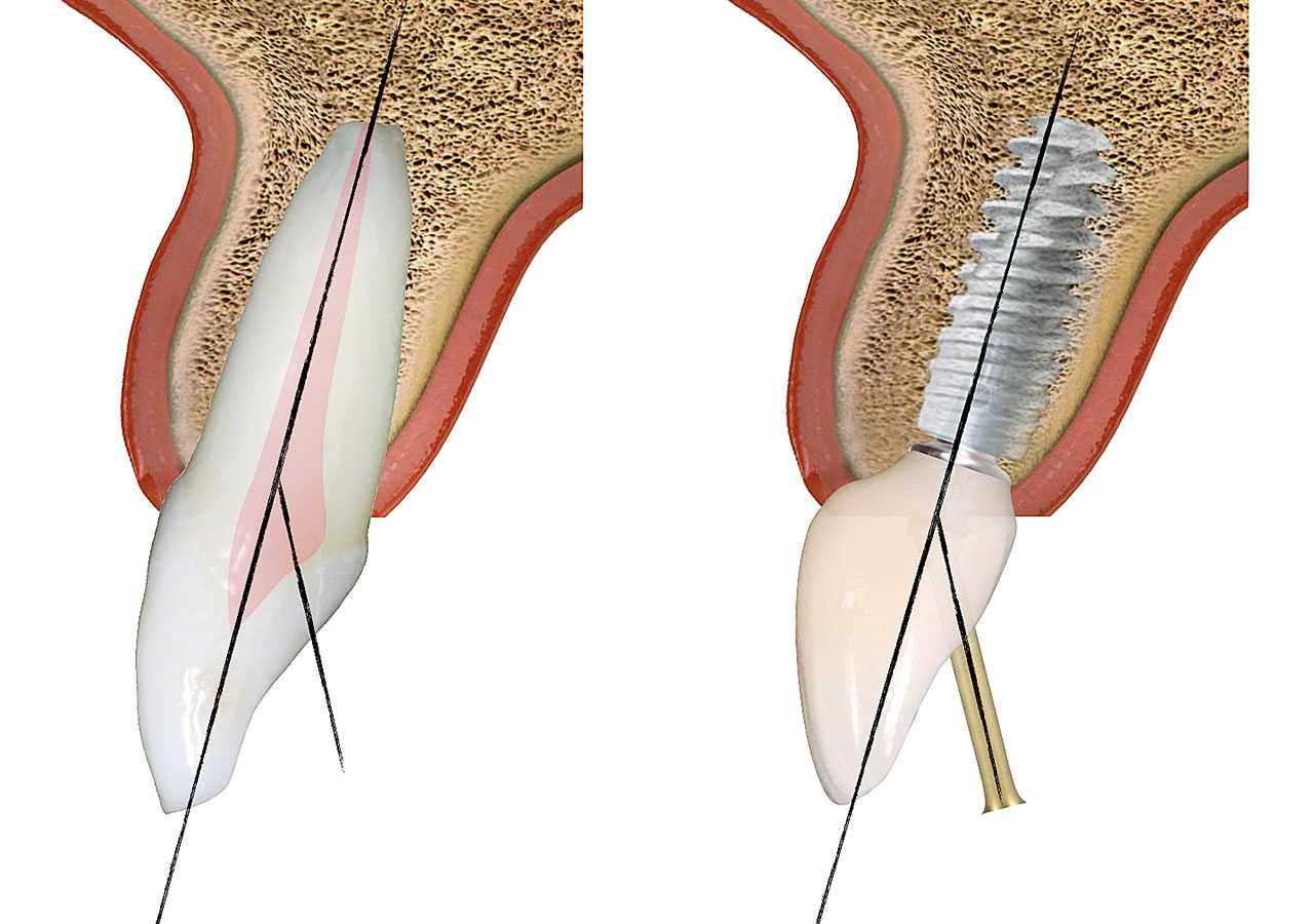 Abb. 4 Die Achsenkompensation ermöglicht es, das Implantat ideal zu positionieren, in Relation zur Knochenanatomie bei gleichzeitiger Lage des Schraubenzugangs im Bereich des Cingulums, sodass die labiale Ästhetik gewahrt bleibt.