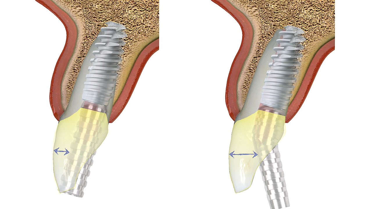 Abb. 7 Mithilfe der angulierten provisorischen Abutments kann ein Schraubenzugang am Cingulum realisiert werden, während das Implantat innerhalb der natürlichen Anatomie des zu ersetzenden Zahns und seiner knöchernen Alveole zu liegen kommt.