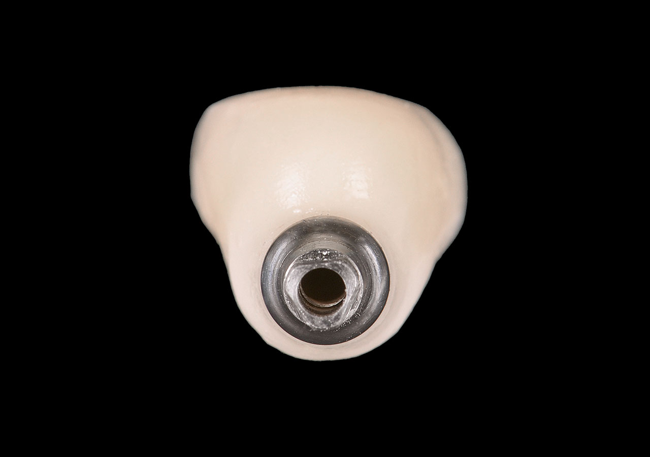 Abb. 14d Definitive Implantatkrone aus keramisch verblendetem Zirkonoxid auf einer AxIN-Titanbasis sowie Befestigungsschraube für die Achsenkompensation. 