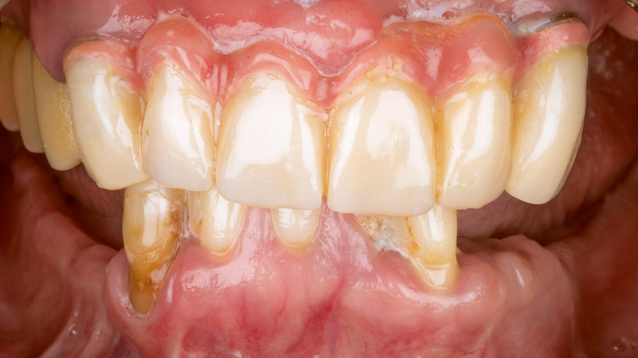 Abb. 3 Beispiel eines Patientenfalles. Die 53-jährige Patientin mit geringer Restbezahnung und insuffizientem Zahnersatz wünscht einen ästhetisch-funktionalen Zahnersatz.  