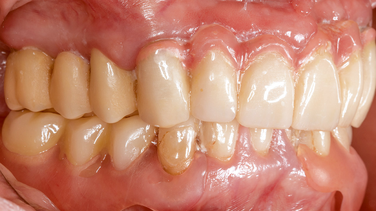 Abb. 4 Beispiel eines Patientenfalles. Die 53-jährige Patientin mit geringer Restbezahnung und insuffizientem Zahnersatz wünscht einen ästhetisch-funktionalen Zahnersatz.  