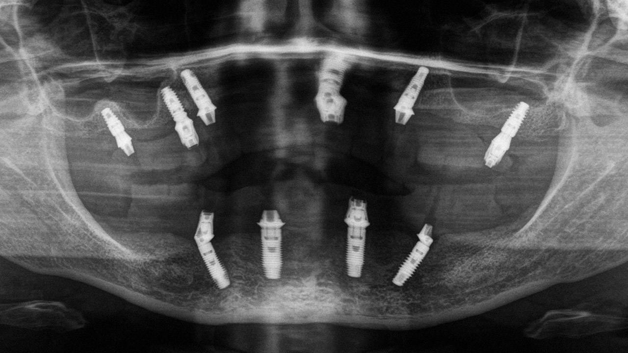 Abb. 7 OPG-Röntgenkontrolle nach der Insertion der Implantate und dem Aufbringen der Aufbauten.