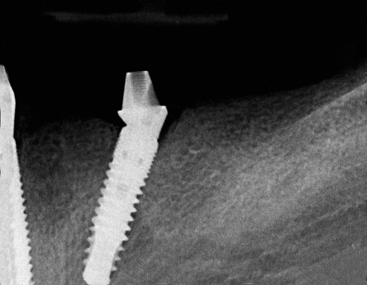 Abb. 8 Röntgenbild eines anguliert inserierten Implantats (Unterkiefer) mit anguliertem SIC Multi-Unit Abutment (Fa. SIC invent).