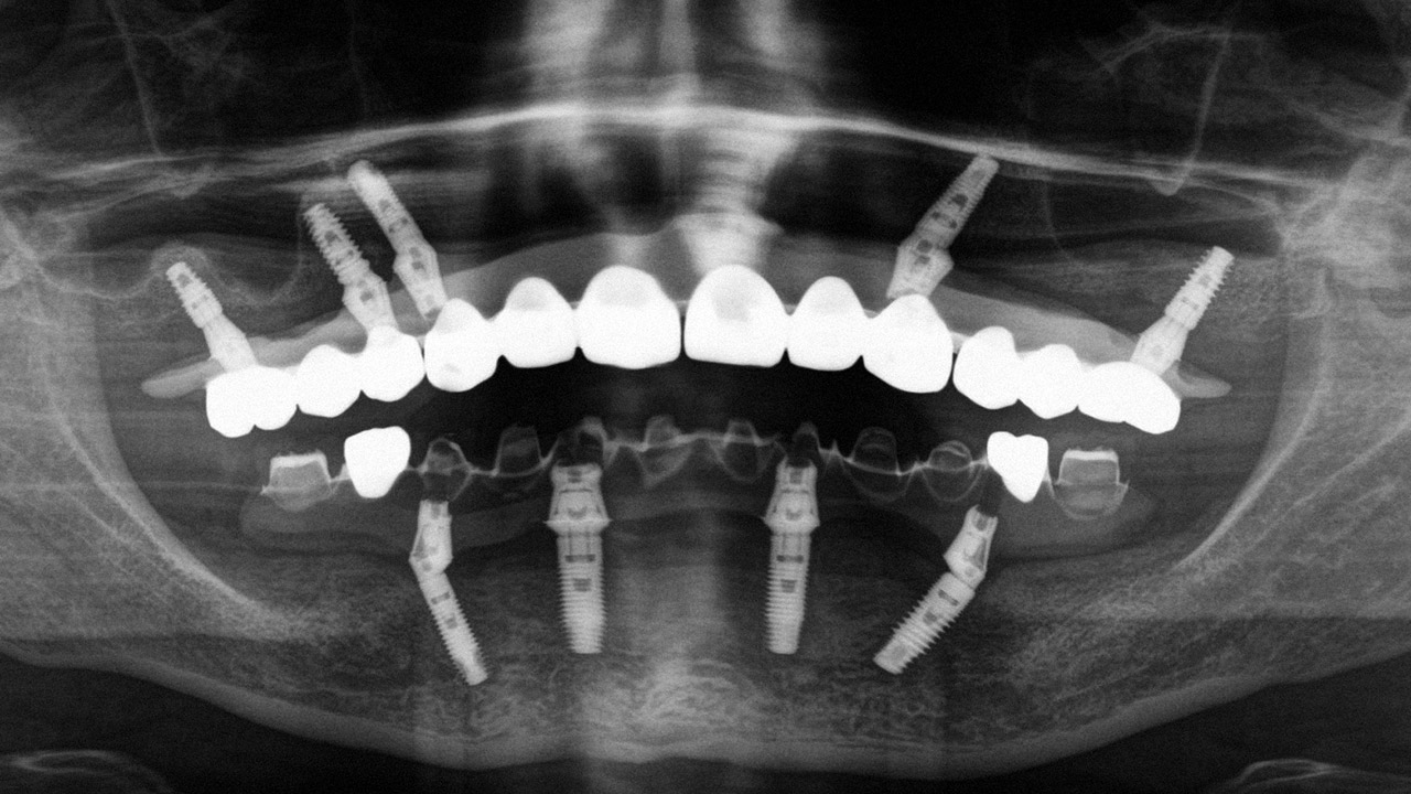 Abb. 19 Abschließendes Röntgenkontrollbild nach der Eingliederung des Zahnersatzes.