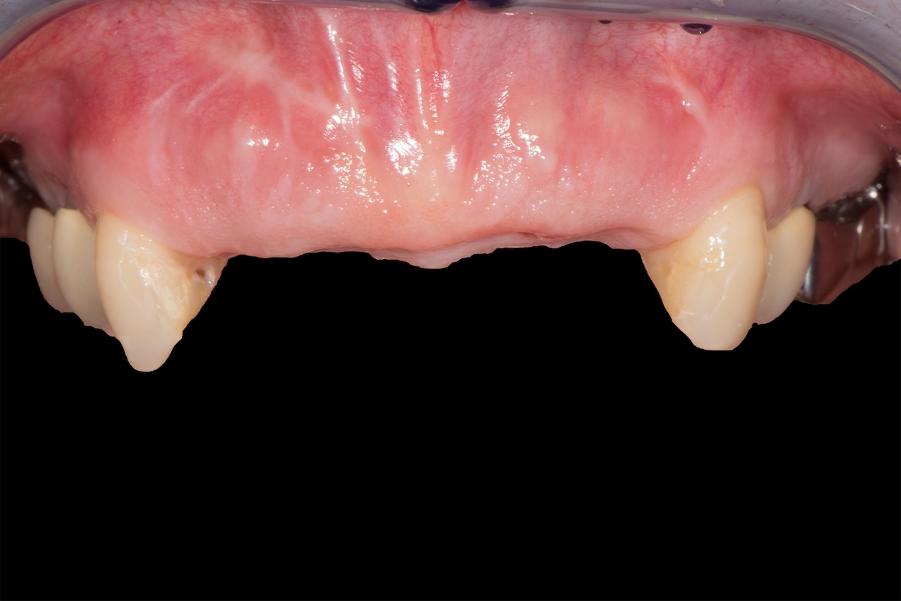 Abb. 3: Klinische Situation acht Wochen nach Extraktion der Zähne 12 bis 22.