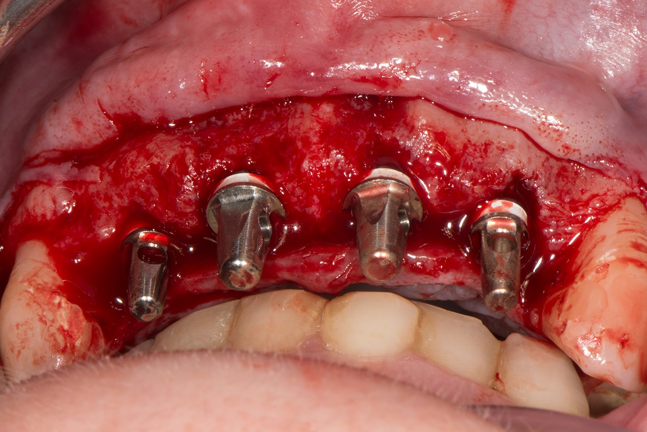 Abb. 8: Positionsindikatoren bei geschlossenem Mund zur Kontrolle der Implantinklinationen in Relation zum Gegenbiss