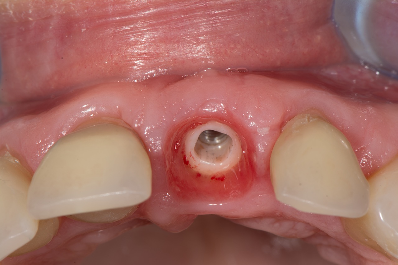 Abb. 13: Periimplantäre Mukosa zwei Monate nach Ausformung des peri-implantären Weichgewebes