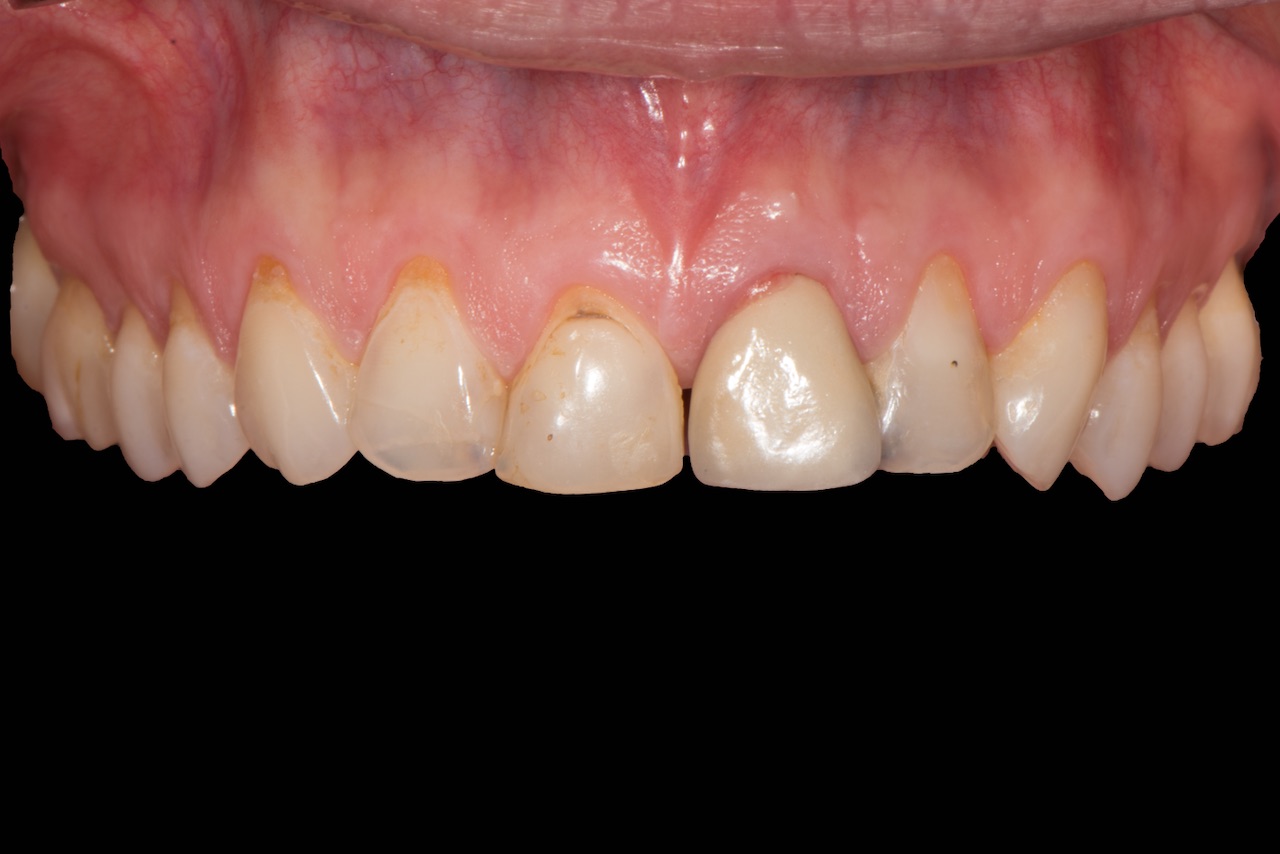 Abb. 2: Klinische Ausgangssituation: Sekundärkaries bei Zahn 21