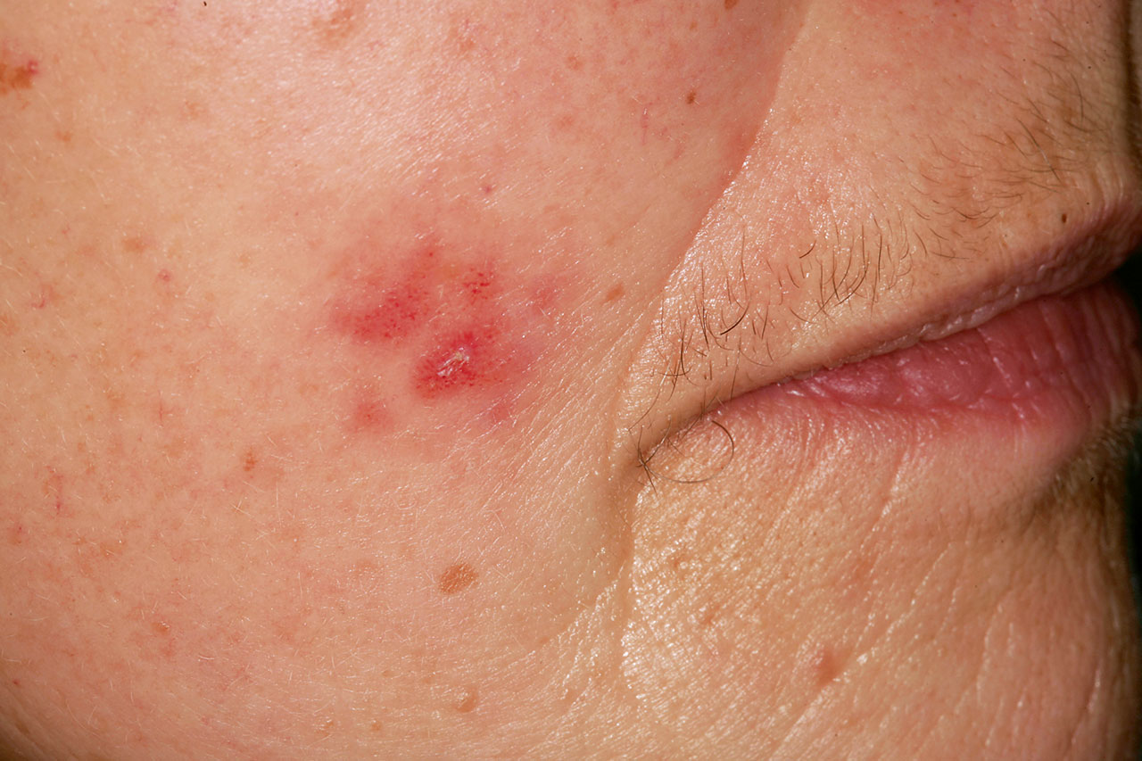 Abb. 1 74-jährige Patientin, 1-2 Tage nach dem ersten Auftreten des Herpes Zoster (Anfangsstadium).