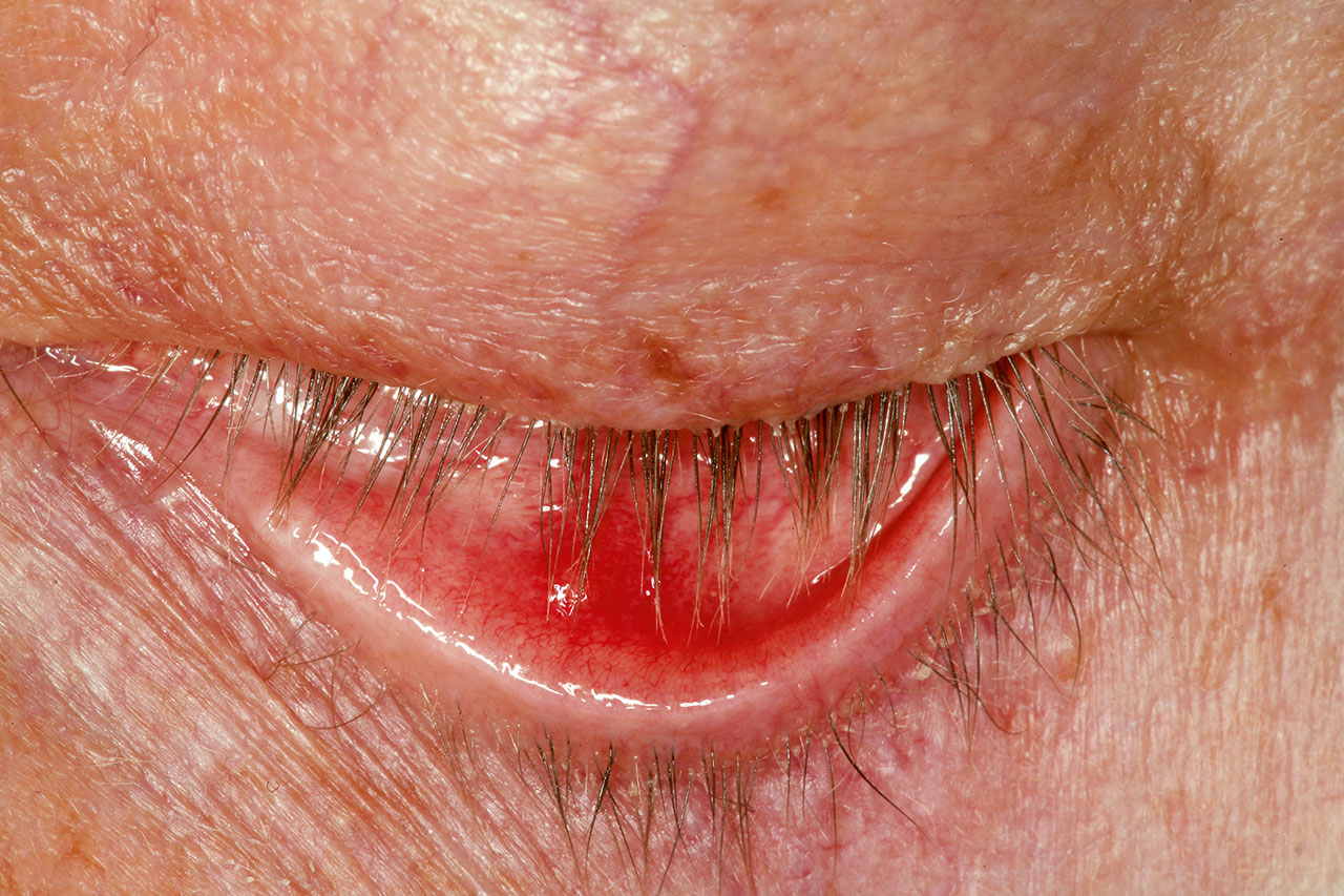 Abb. 5 59-jährige Patientin, Herpes ­Zoster ophthalmicus.