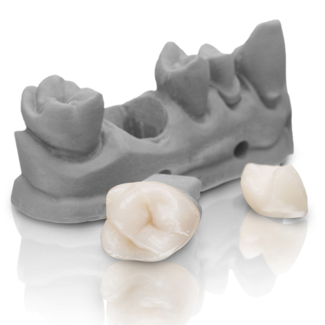 VarseoSmile Crown plus ist das weltweit erste zugelassene zahnfarbene, keramisch gefüllte Hybridmaterial für den 3D-Druck von permanenten Einzelkronen, Inlays, Onlays und Veneers.