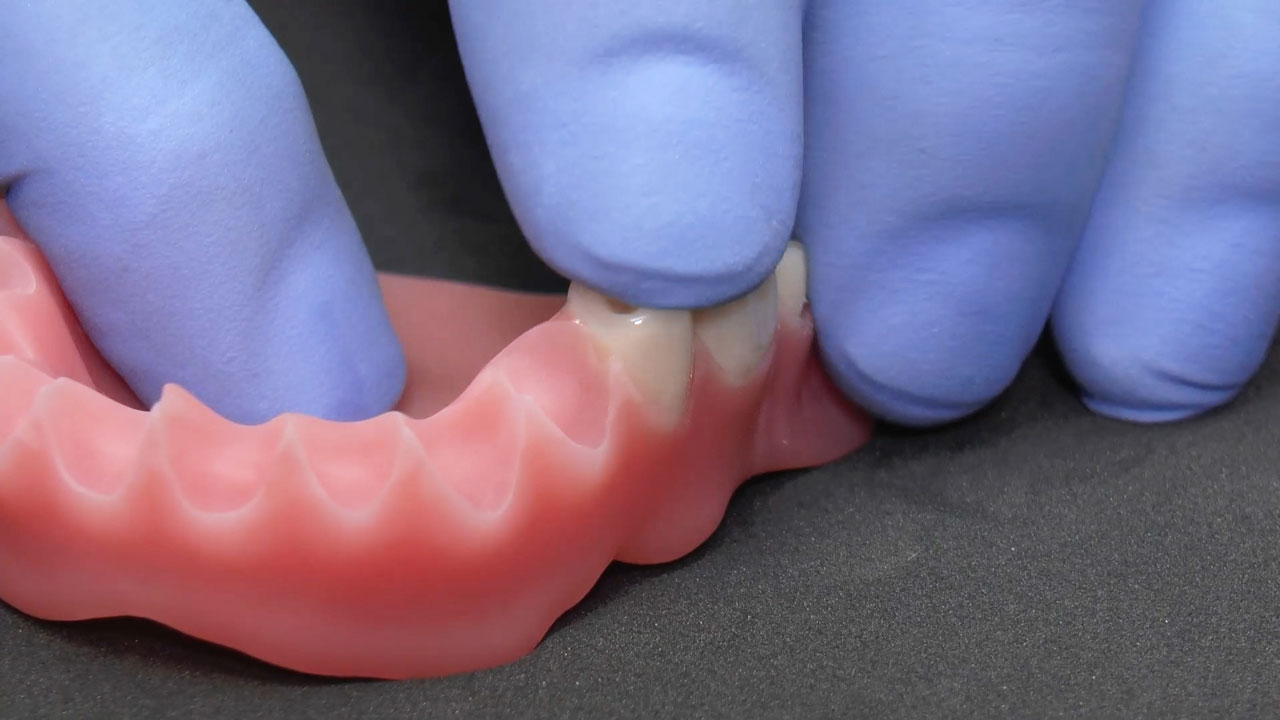 Abb. 10: Die Zähne werden nacheinander einfach und prozesssicher 
mit dem Spezialkleber lagestabil in den Alveolen befestigt.
