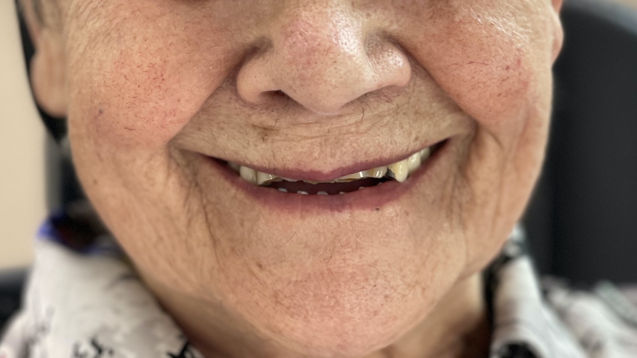 82-jährige Patientin – die Prothese im Unterkiefer war verloren, die Zähne im Oberkiefer stark abradiert.
