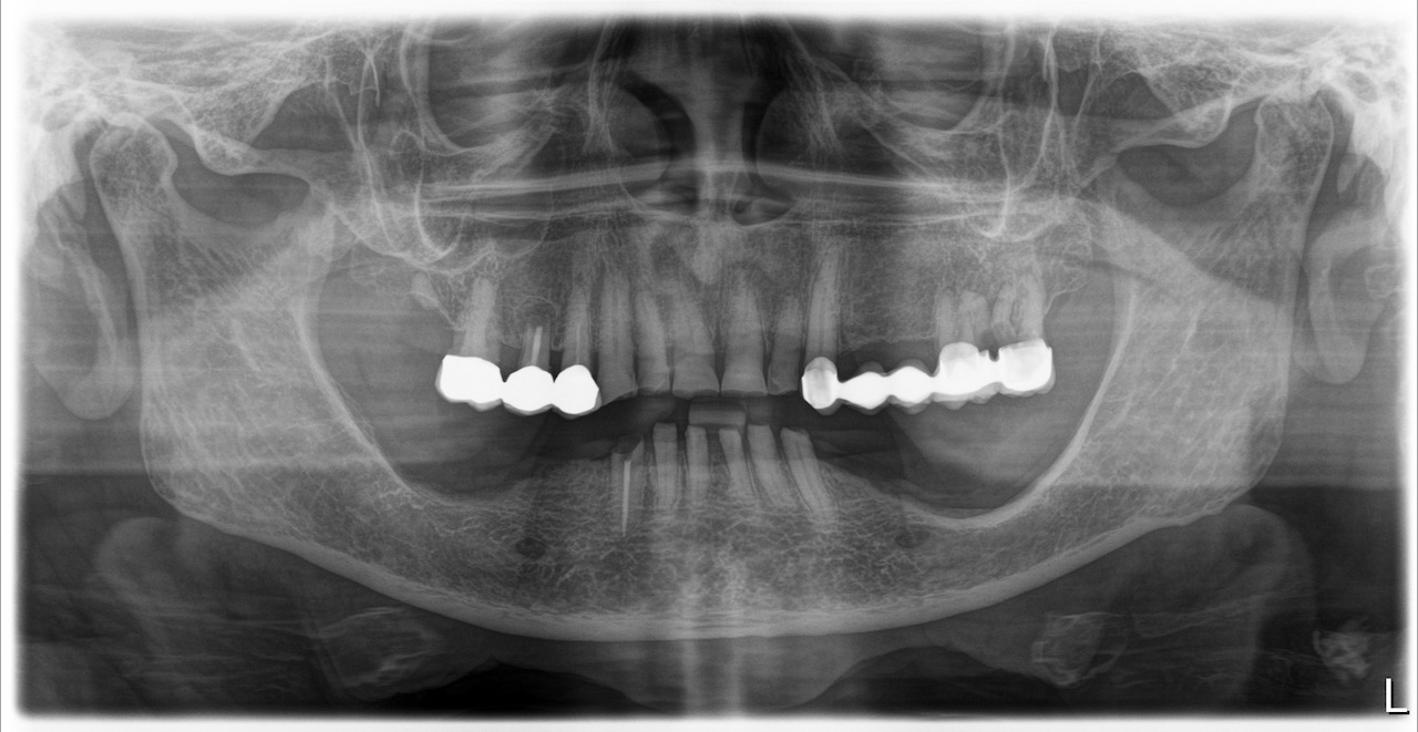 Situation im OPG, Zahn 43 ist endodontisch behandelt