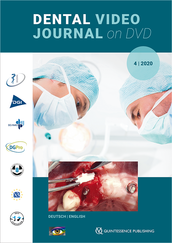 (DGZMK): Dental Video Journal 4/2020