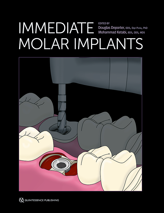 Deporter: Immediate Molar Implants