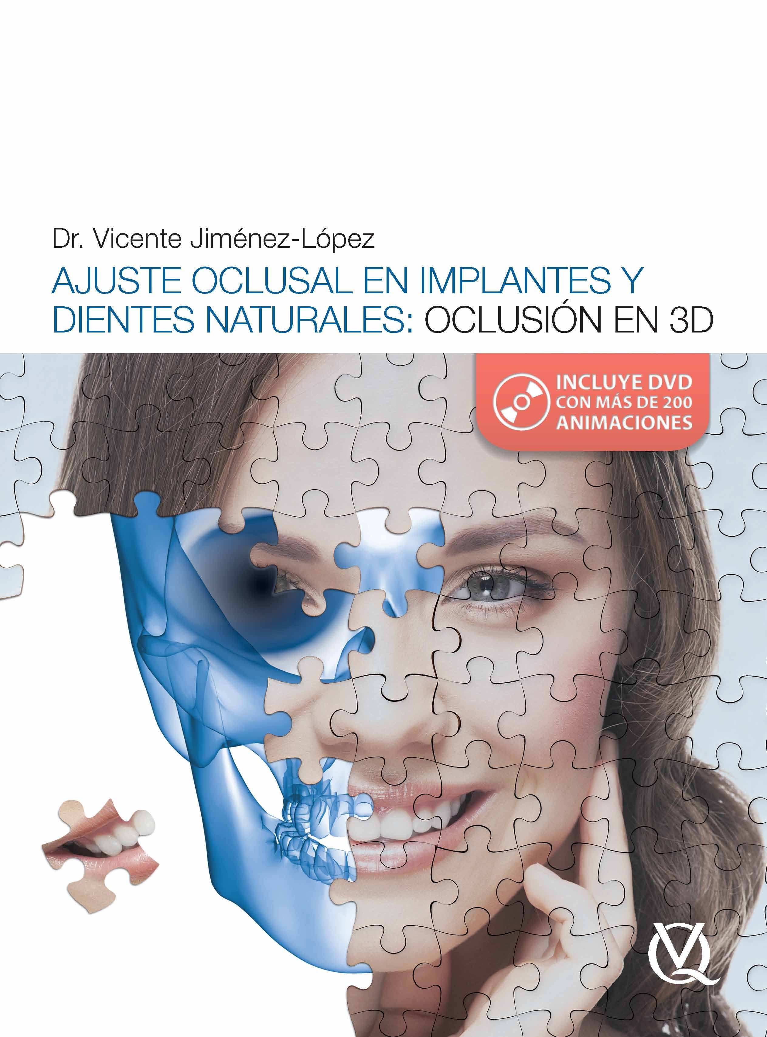 Jiménez-López: Ajuste Oclusal en Implantes y Dientes Naturales