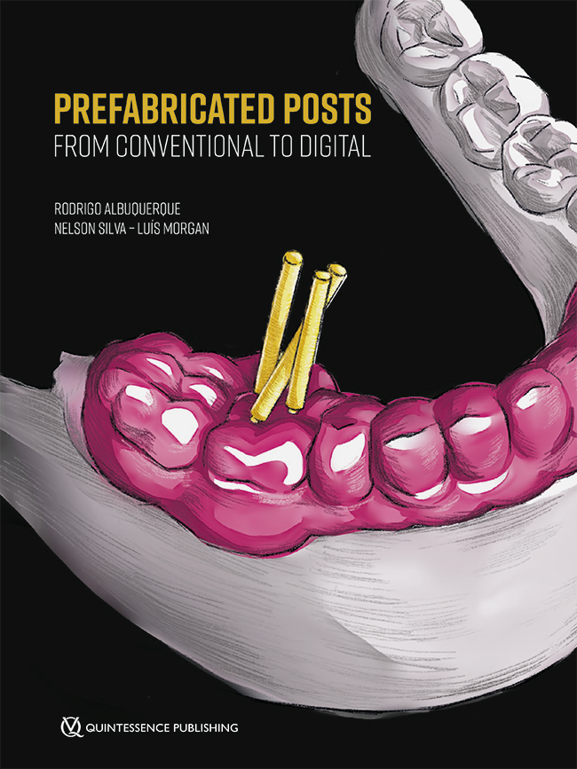 Albuquerque: Prefabricated Posts