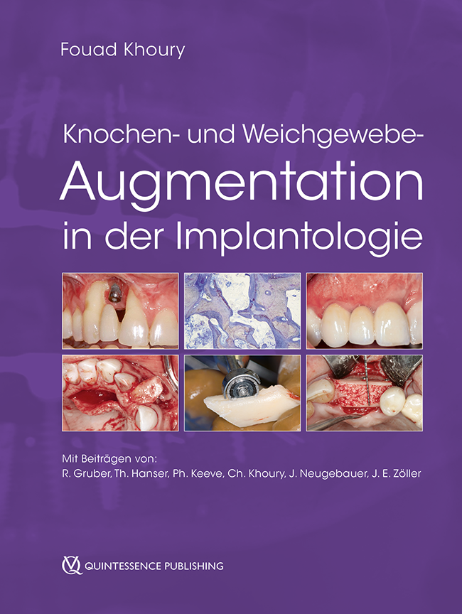 Khoury: Knochen- und Weichgewebeaugmentation in der Implantologie