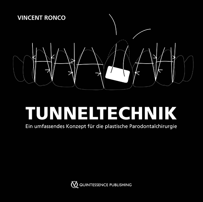 Ronco: Tunneltechnik