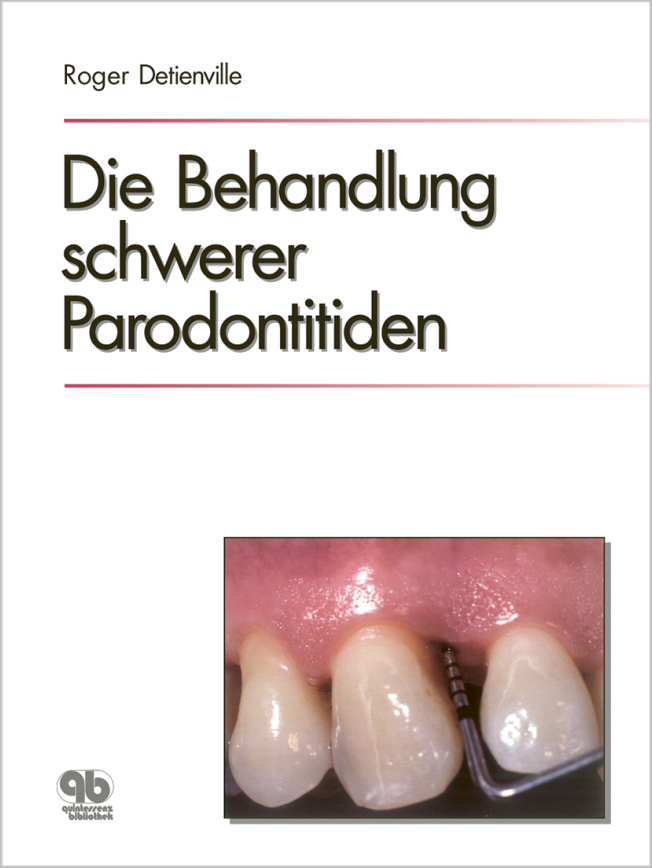 Detienville: Die Behandlung schwerer Parodontitiden