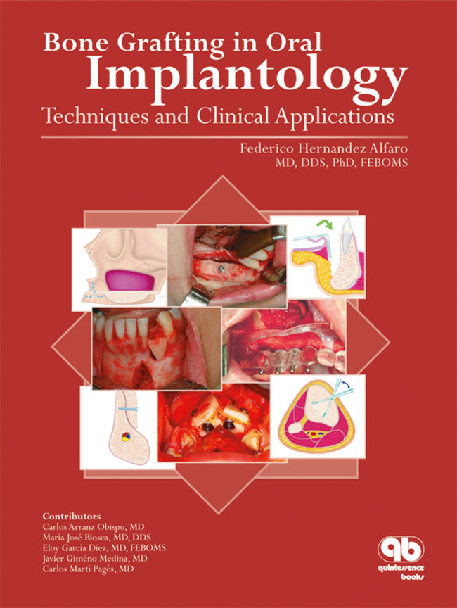 Alfaro: Bone Grafting in Oral Implantology
