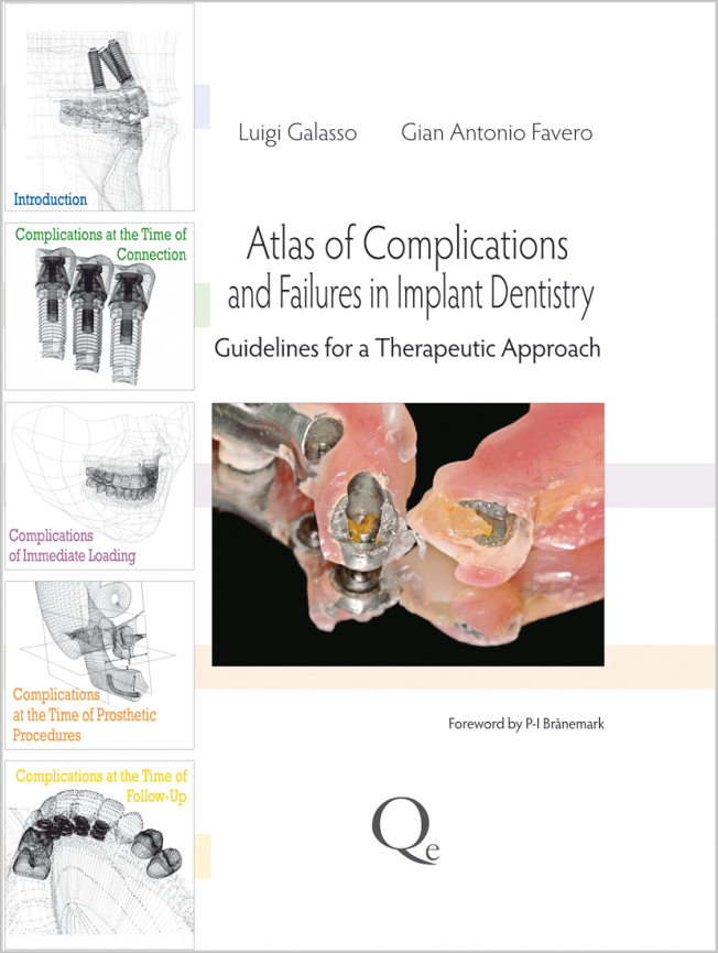Galasso: Atlas of Complications and Failures in Implant Dentistry